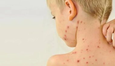 Alarma en el Garraf (Barcelona) por un brote de sarampión con ocho afectados, seis de ellos sin vacunar