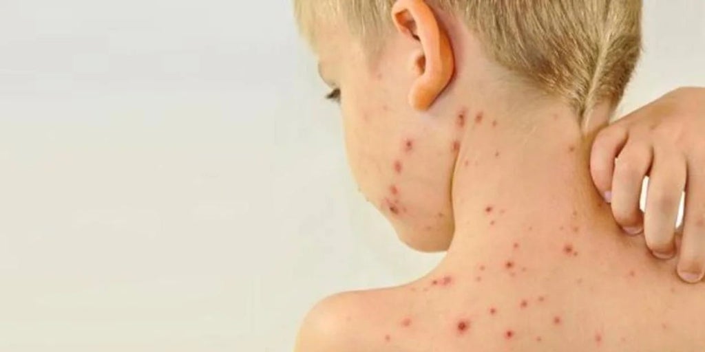 Alarma en el Garraf (Barcelona) por un brote de sarampión con ocho afectados, seis de ellos sin vacunar