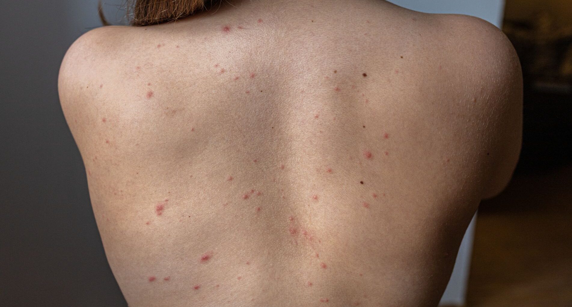 Los casos de sarna detectados en España se multiplican por 50 entre 2011 y 2023