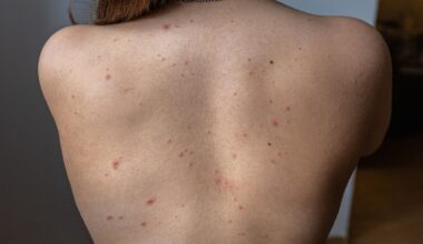 Los casos de sarna detectados en España se multiplican por 50 entre 2011 y 2023