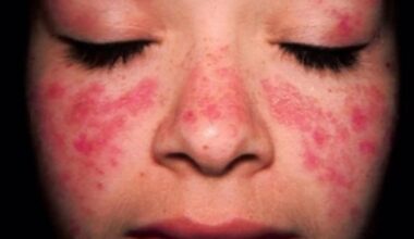 un virus presente en el 95% de las personas puede desencadenarlo