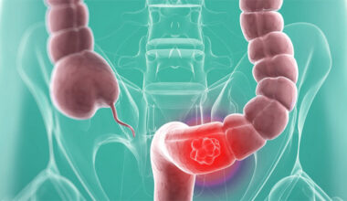 cáncer-colorrectal-metastásico