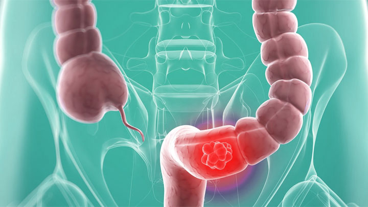 cáncer-colorrectal-metastásico
