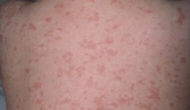 El sarampión vuelve a Canadá y se extiende por EEUU ante la caída de la vacunación infantil - Expansión