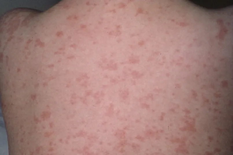 El sarampión vuelve a Canadá y se extiende por EEUU ante la caída de la vacunación infantil - Expansión