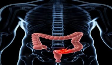 Investigadores españoles descubren por qué la inmunoterapia no funciona en el cáncer colorrectal metastásico