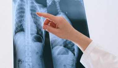 Oncólogos avisan del aumento del cáncer de pulmón en no fumadores