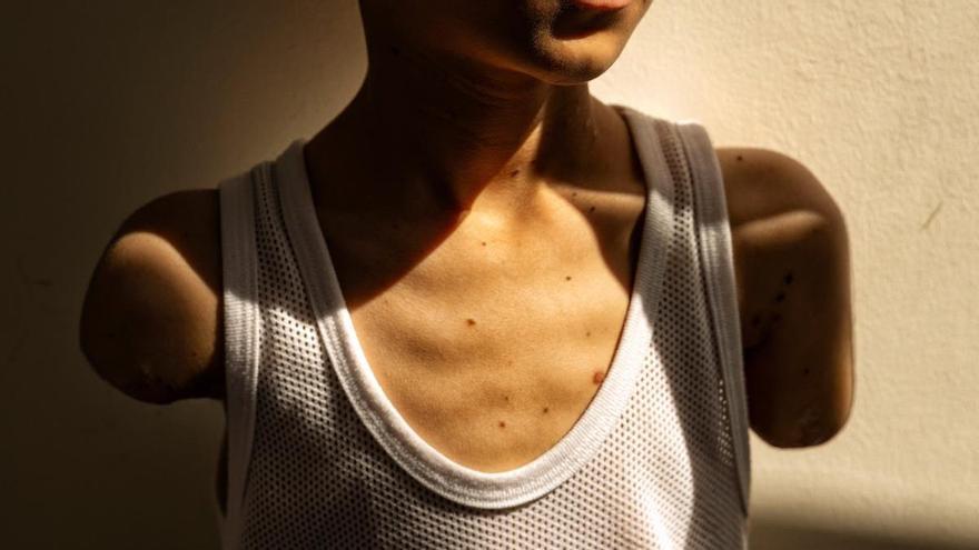 Un niño gazatí amputado por un ataque israelí, imagen ganadora del World Press Photo