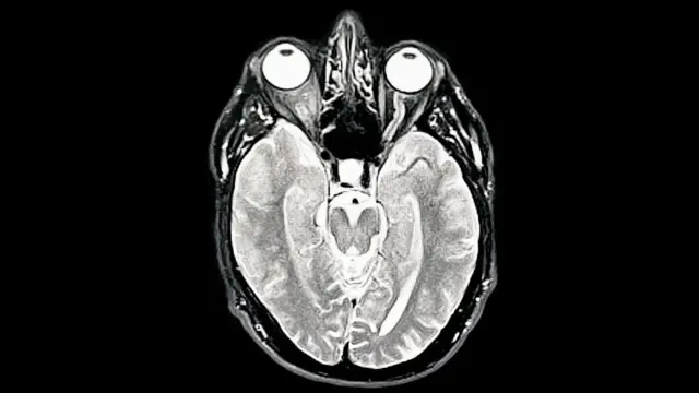 Una tomografía MIR del cerebro del fotógrafo muestra demencia temprana/Alzheimer