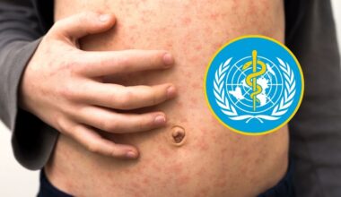 Brotes de sarampión en 59 países evidencian fragilidad de la cobertura vacunal mundial