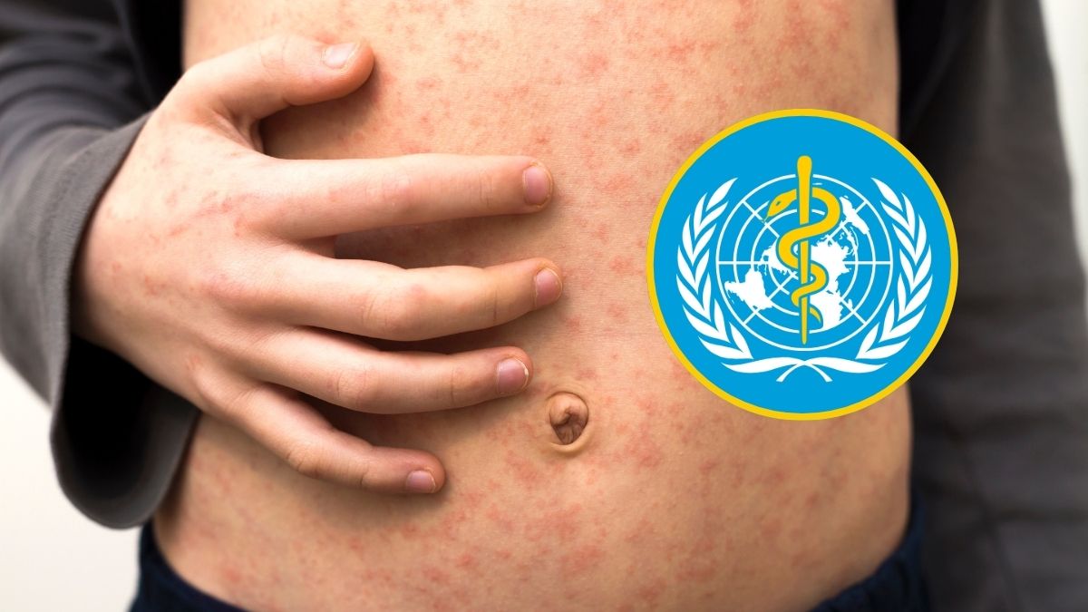 Brotes de sarampión en 59 países evidencian fragilidad de la cobertura vacunal mundial