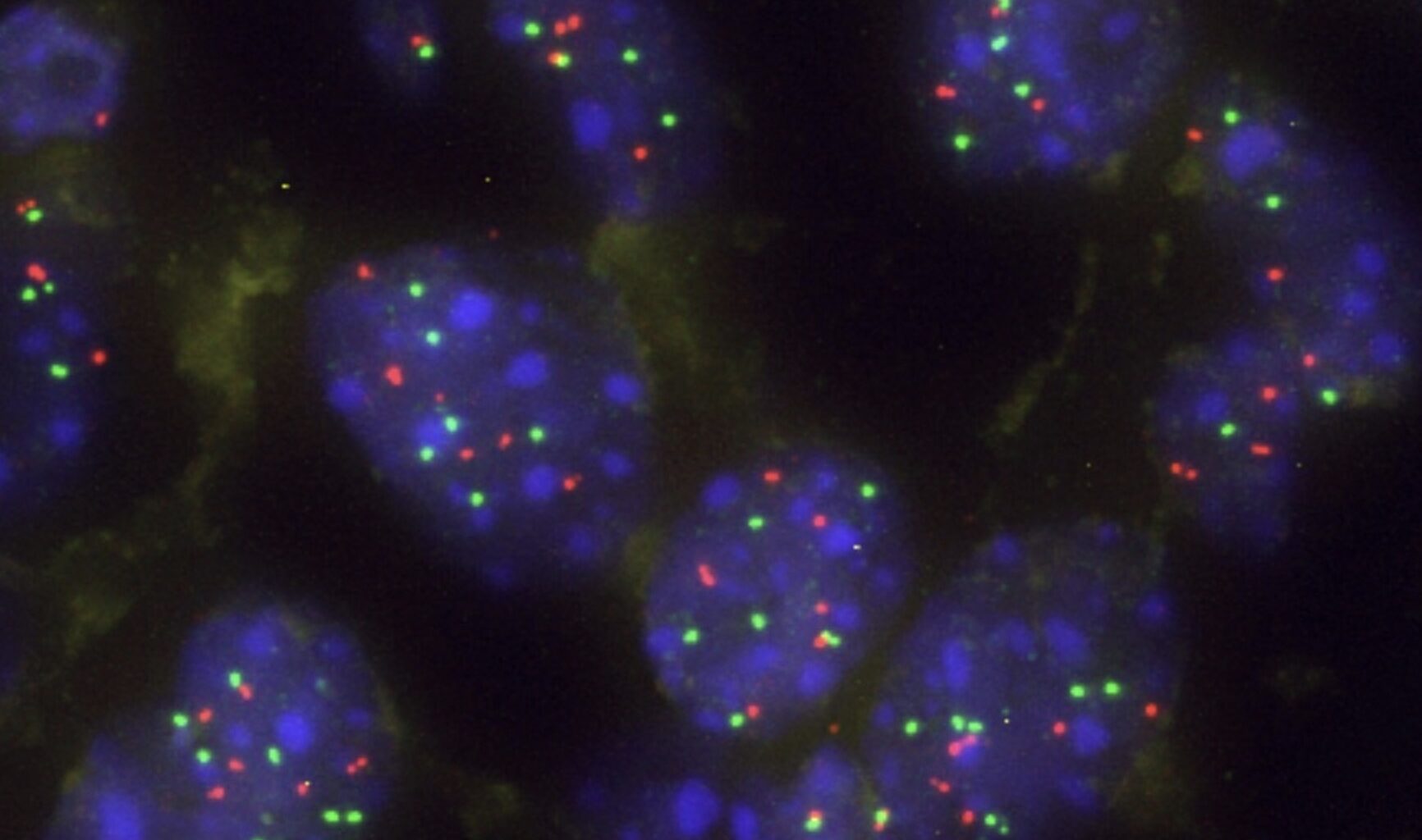Una proteína actúa como barrera natural frente a la progresión del cáncer de pulmón