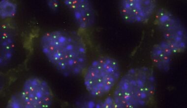 Una proteína actúa como barrera natural frente a la progresión del cáncer de pulmón