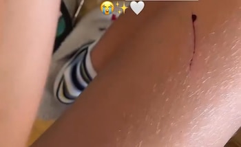 A pesar del accidente, Zoe