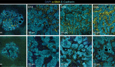 El cáncer colorrectal se protege de la inmunoterapia con una doble barrera
