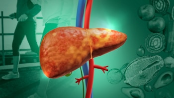 Cómo revertir el hígado graso