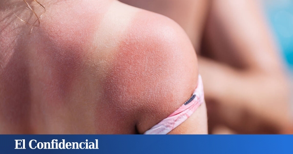 Estudian la piel humana y descubren que las quemaduras solares (controladas) pueden prevenir el cáncer