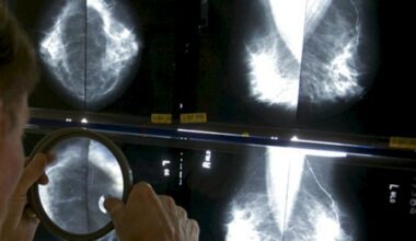 CamON-cáncer-mama- metastásico