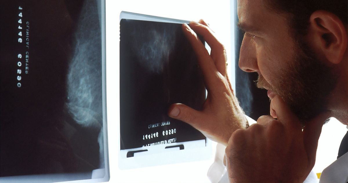 estadísticas y prevención del cáncer de próstata