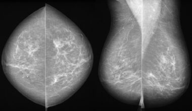 Cribado del cáncer de mama