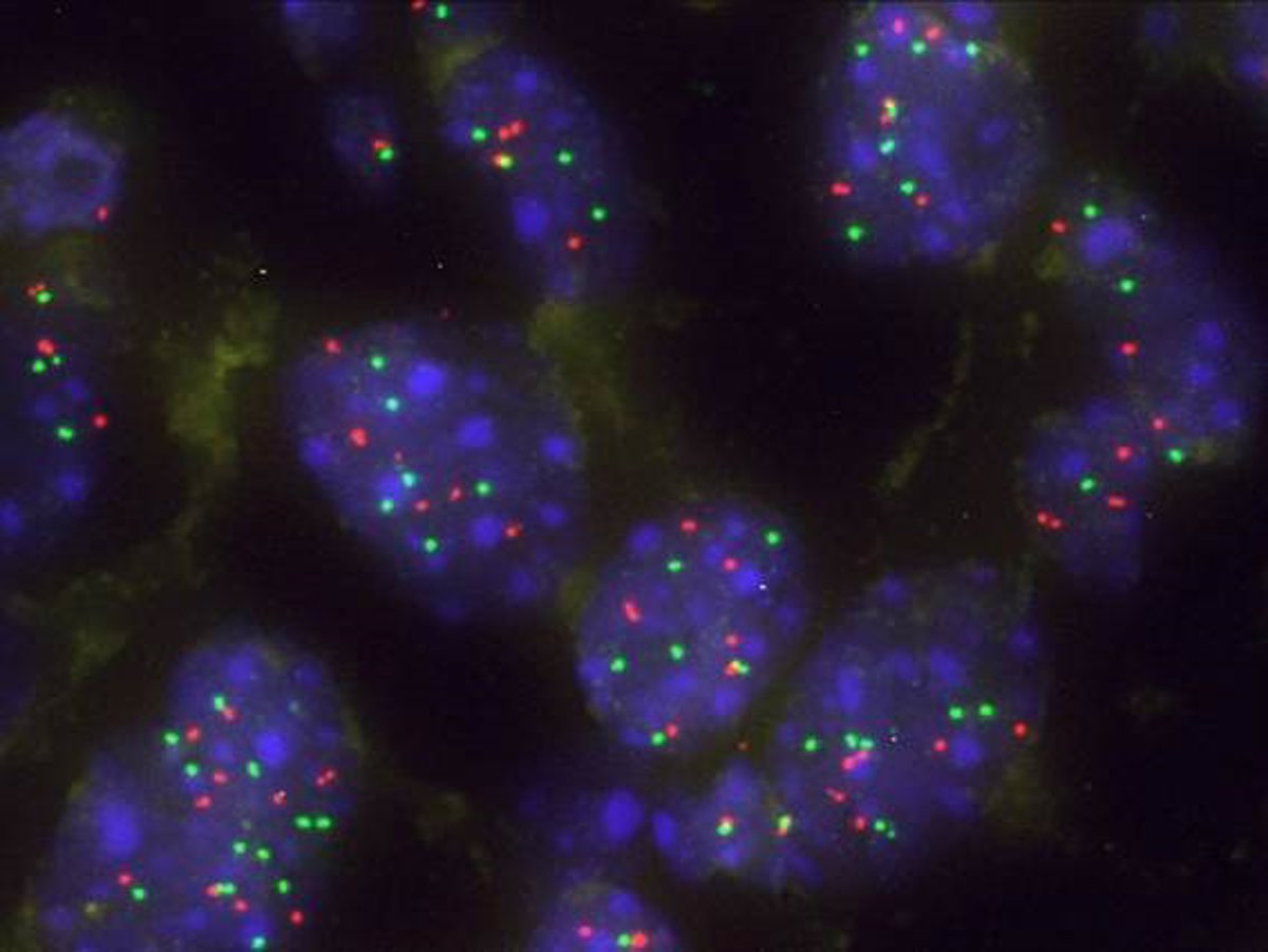 la proteína que emerge como nueva diana para tumores pulmonares con mutaciones KRAS y TP53