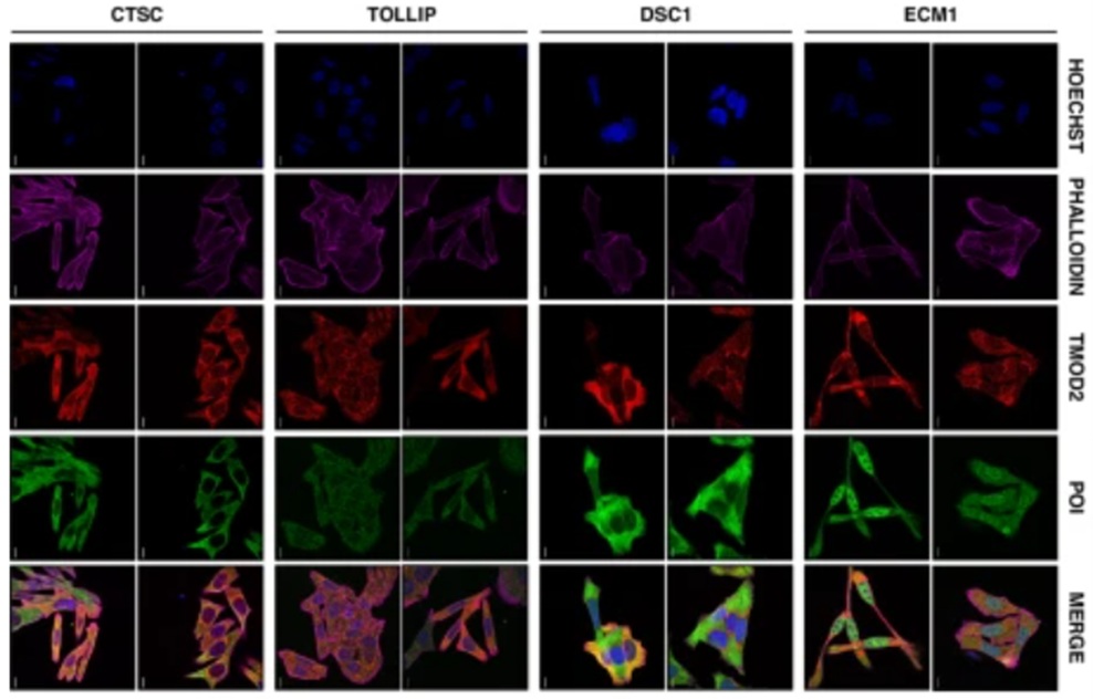 Proteína clave en el cáncer colorrectal identificada