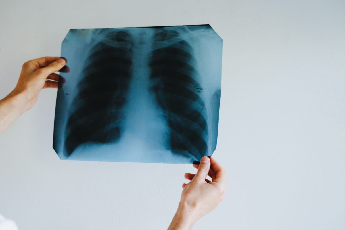 El 75 de los casos de EPOC siguen sin diagnosticar