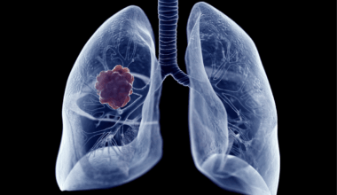 España se enmarca como el país occidental donde más crece el cáncer de pulmón femenino