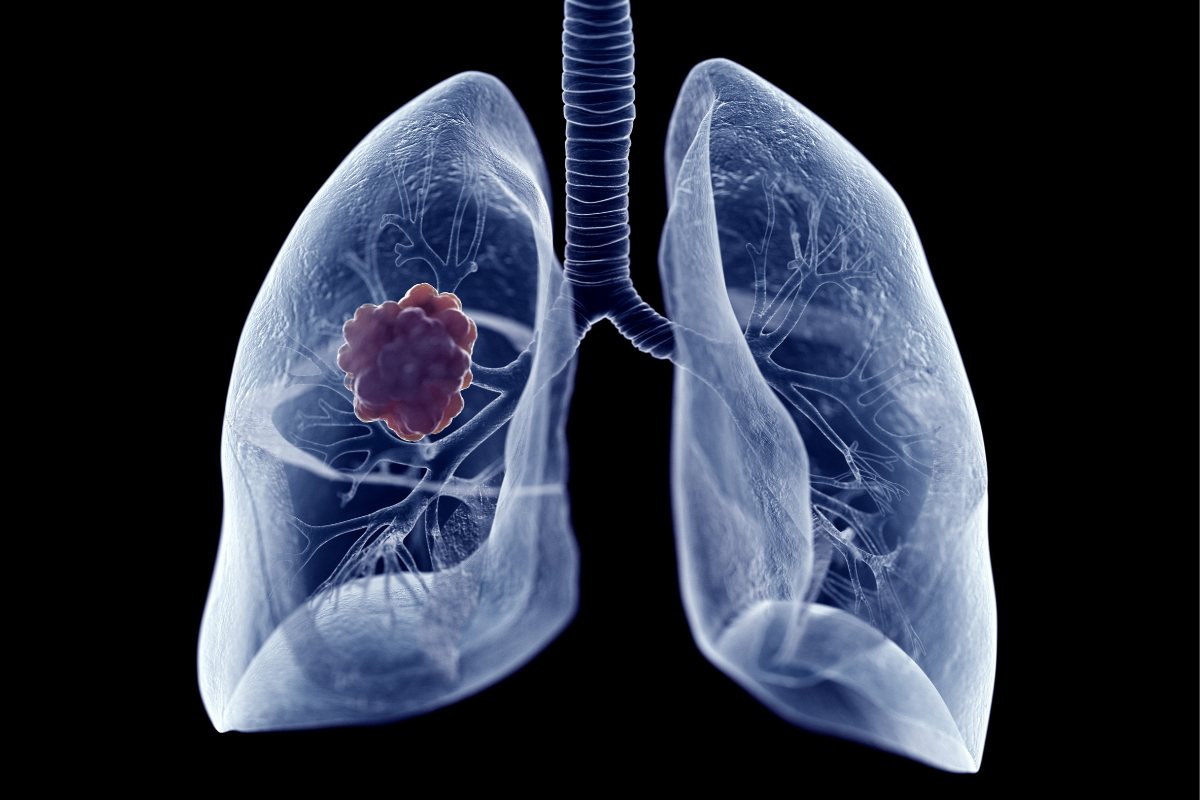 España se enmarca como el país occidental donde más crece el cáncer de pulmón femenino