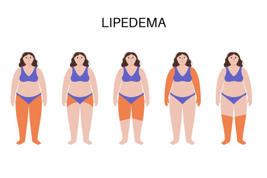 lipedema   stock original