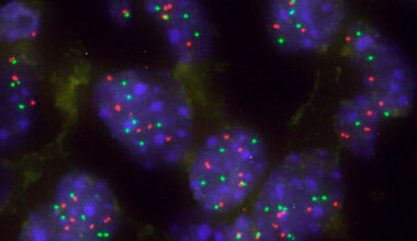 Encuentran una barrera natural frente a la progresión del cáncer de pulmón: es una proteína