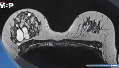 Alta densidad mamográfica podría asociarse con tumores de mama de peor pronóstico, según estudio