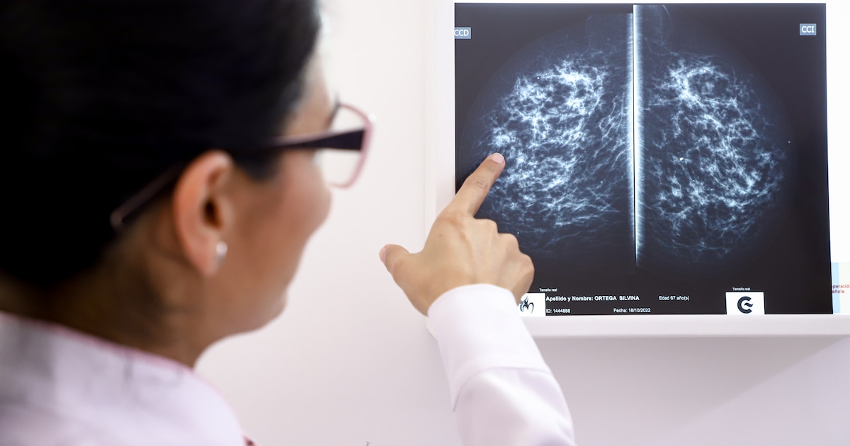 Cáncer de mama: cómo se altera el reloj biológico del organismo antes de que el tumor sea detectable