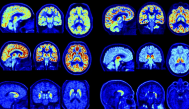 Nuevo escáner PET permite detectar trastornos cerebrales con mayor precisión y antelación