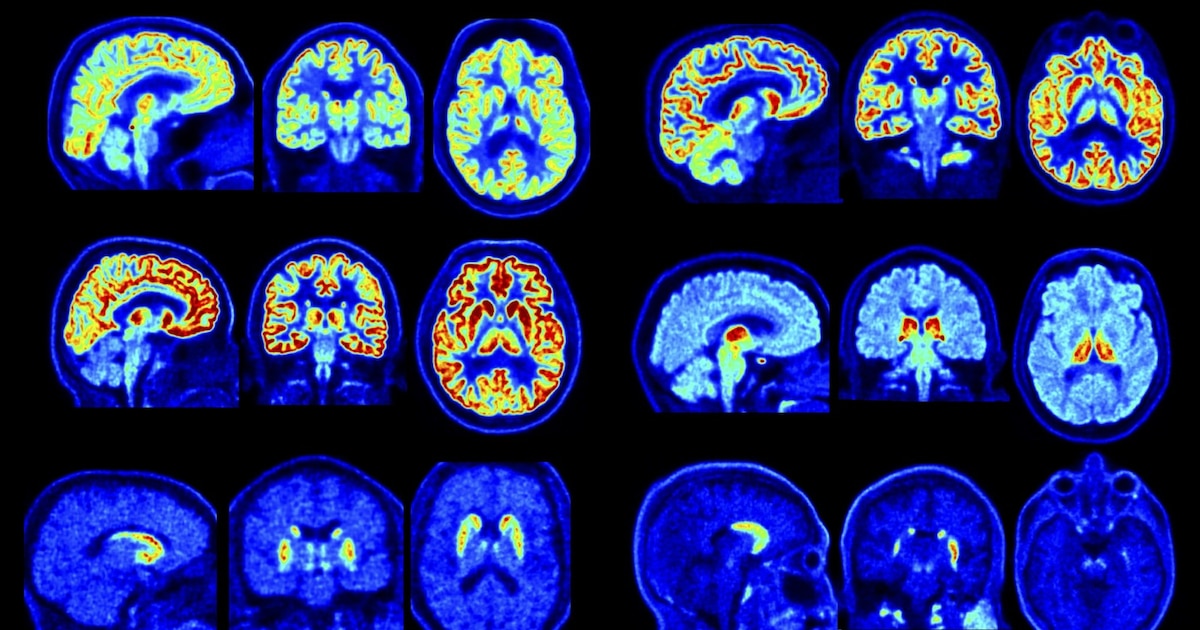 Nuevo escáner PET permite detectar trastornos cerebrales con mayor precisión y antelación