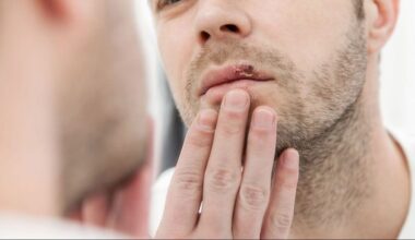 Conviviendo con los herpes