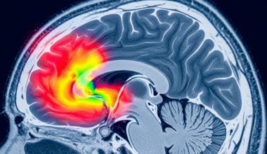 ACV transitorio: las señales silenciosas que alertan antes de un derrame y pueden salvar la vida, según expertos