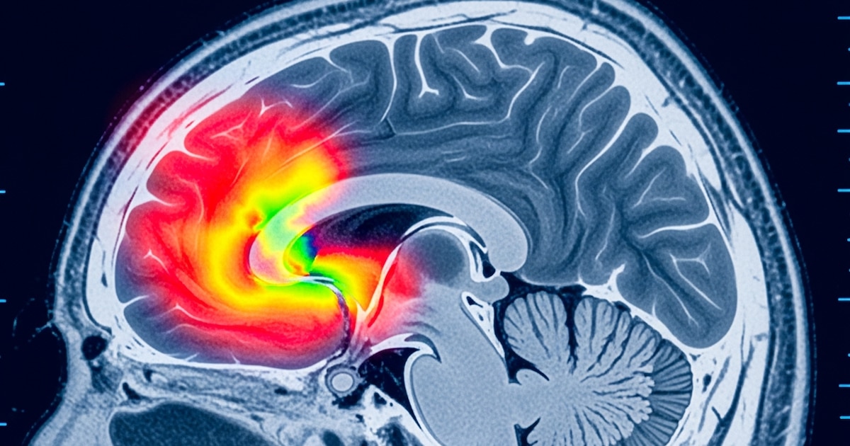 ACV transitorio: las señales silenciosas que alertan antes de un derrame y pueden salvar la vida, según expertos