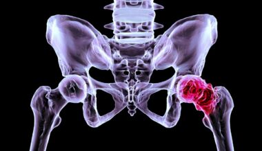 Descubren por qué se destruye el cartílago en la artrosis y cómo regenerarlo