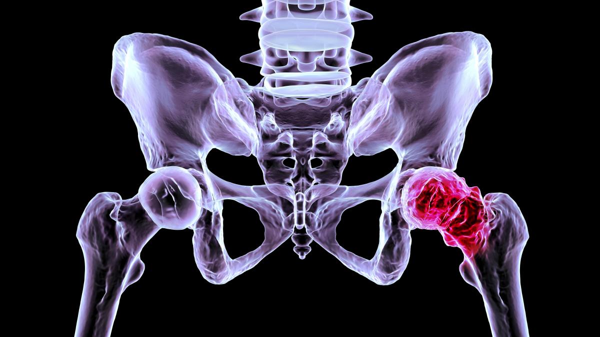 Descubren por qué se destruye el cartílago en la artrosis y cómo regenerarlo