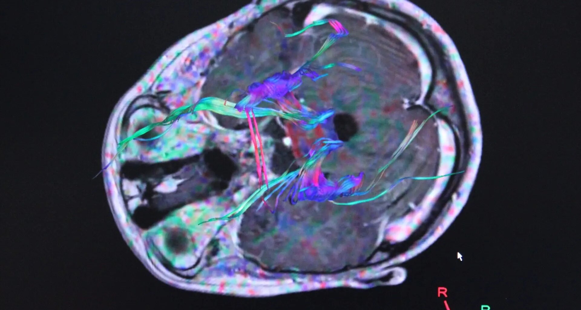 Hallan un patrón en enfermedades de cerebro e intestino que mejoraría la detección del Párkinson