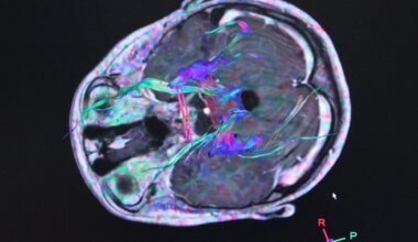 Hallan un patrón en enfermedades de cerebro e intestino que mejoraría la detección del Párkinson