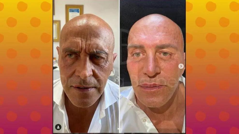 Kiko Matamoros después de otra intervención