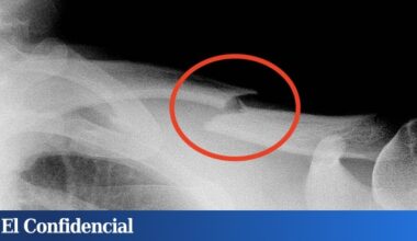 Hacen un experimento con ratones y descubren cómo revertir los efectos de la osteoporosis definitivamente