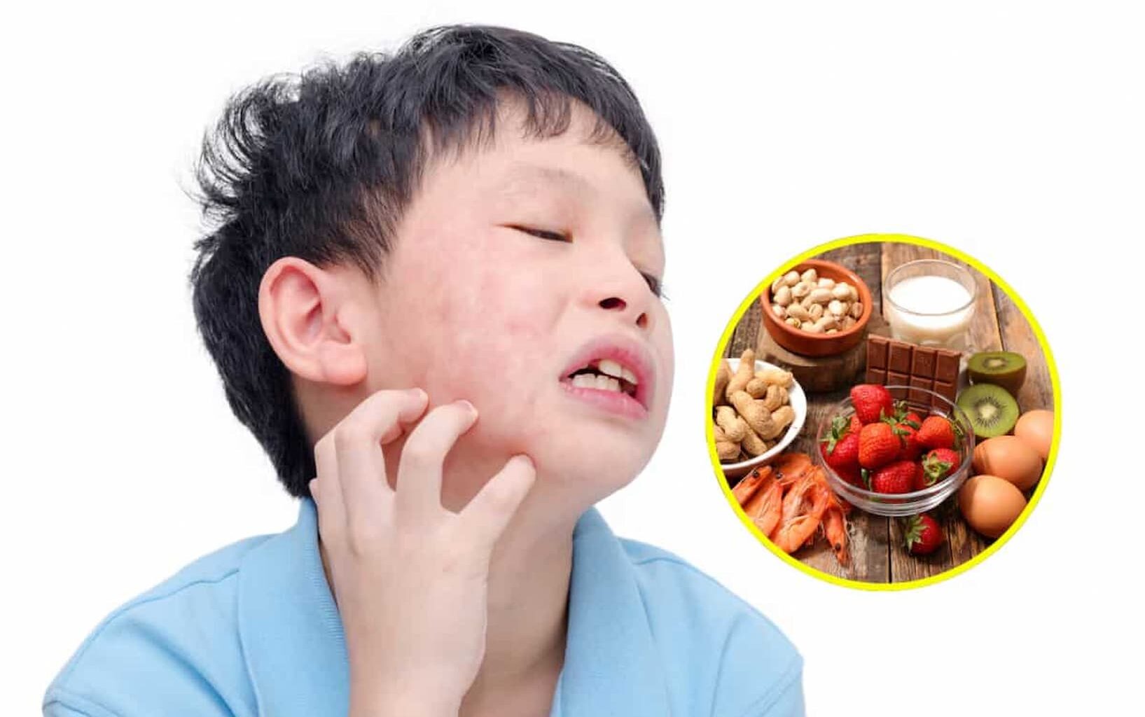 Vacuna experimental promete proteger un año de alergias graves