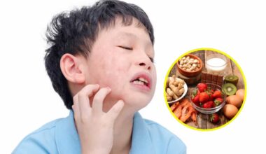 Vacuna experimental promete proteger un año de alergias graves