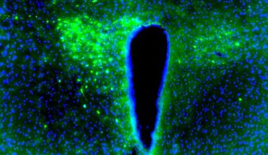 El cáncer de mama desincroniza las neuronas por la noche para seguir avanzando