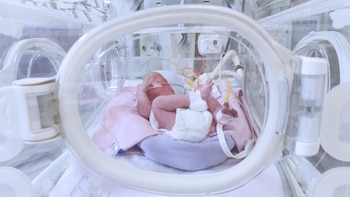 El riesgo de desarrollar displasia