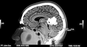 El NeuroEXPLORER reduce la cantidad