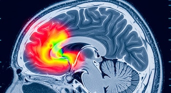 El accidente isquémico transitorio es